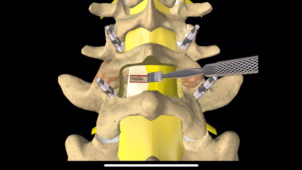 Posterior lumbar interbody fusion with cage Technique